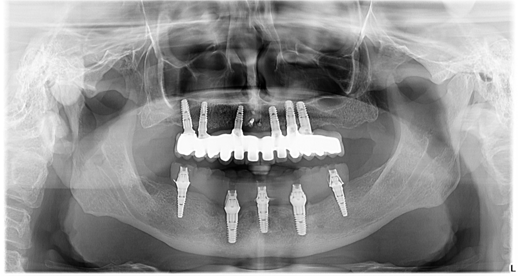 implant dentar intr-o zi in cluj
