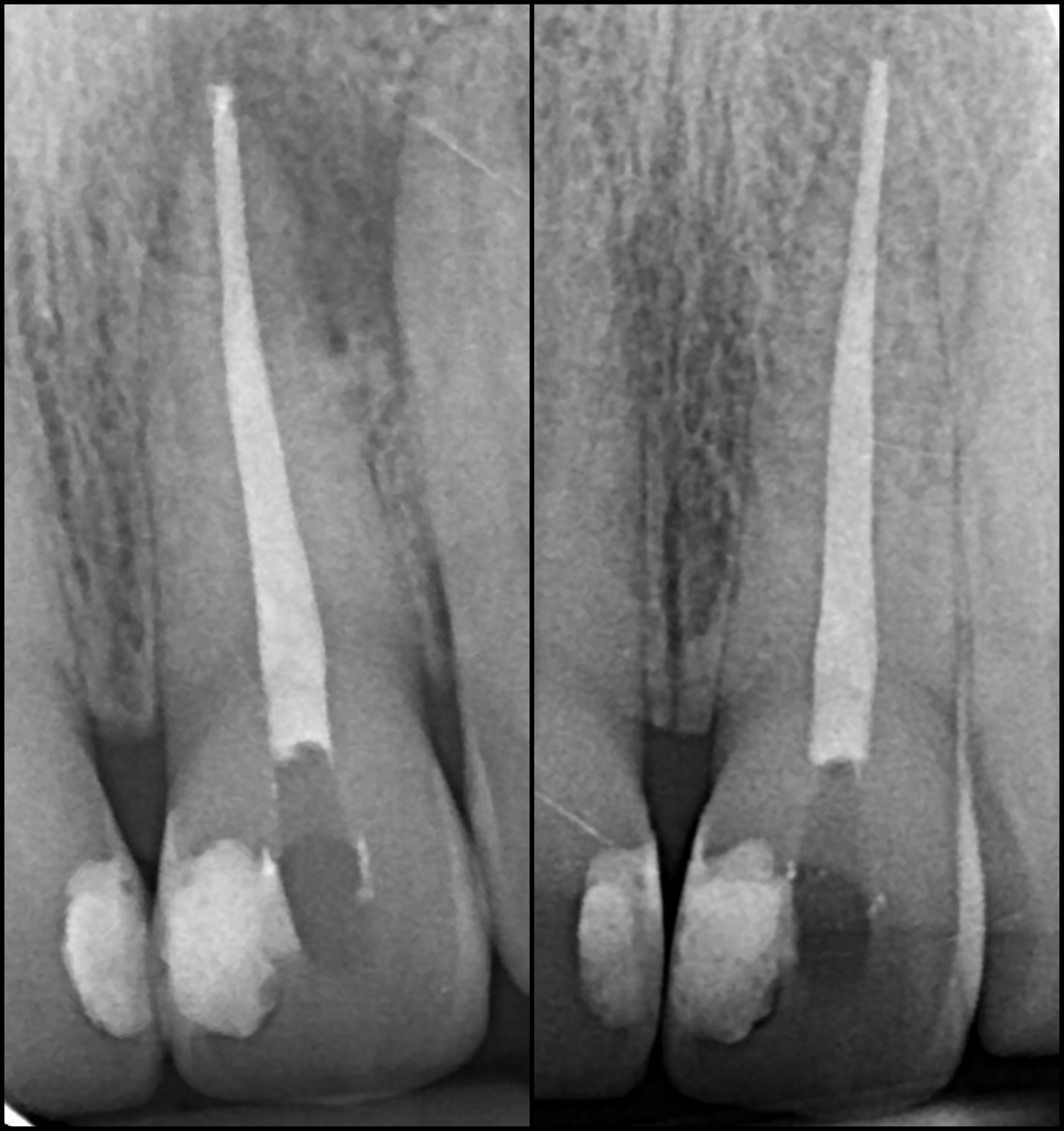 infecția de la rădăcina dinților se poate vindeca