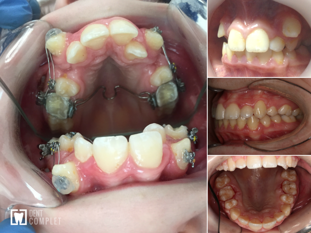 interventie ortodontica cluj