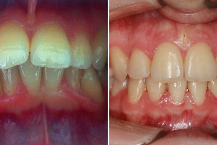 caz-ortodontic-cluj