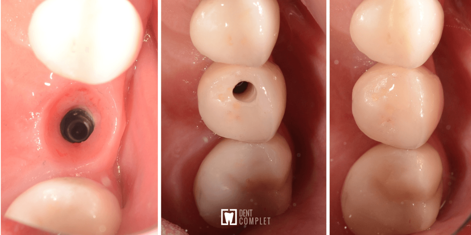 implanturi-dentare-in-cluj