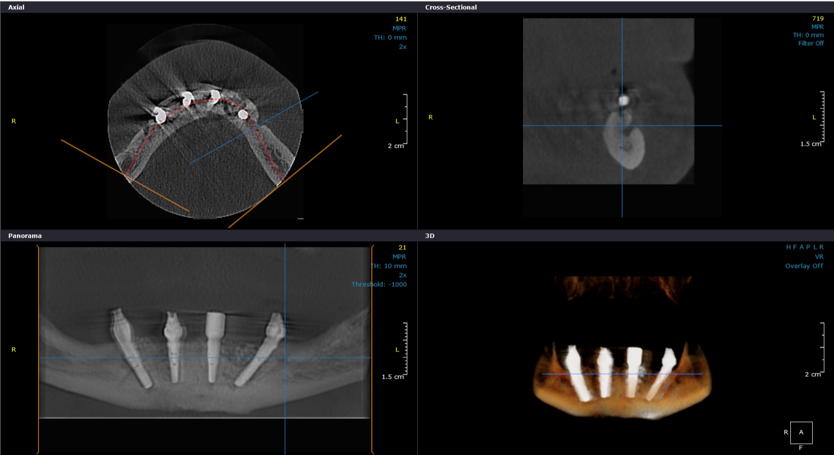 CT implant dentar