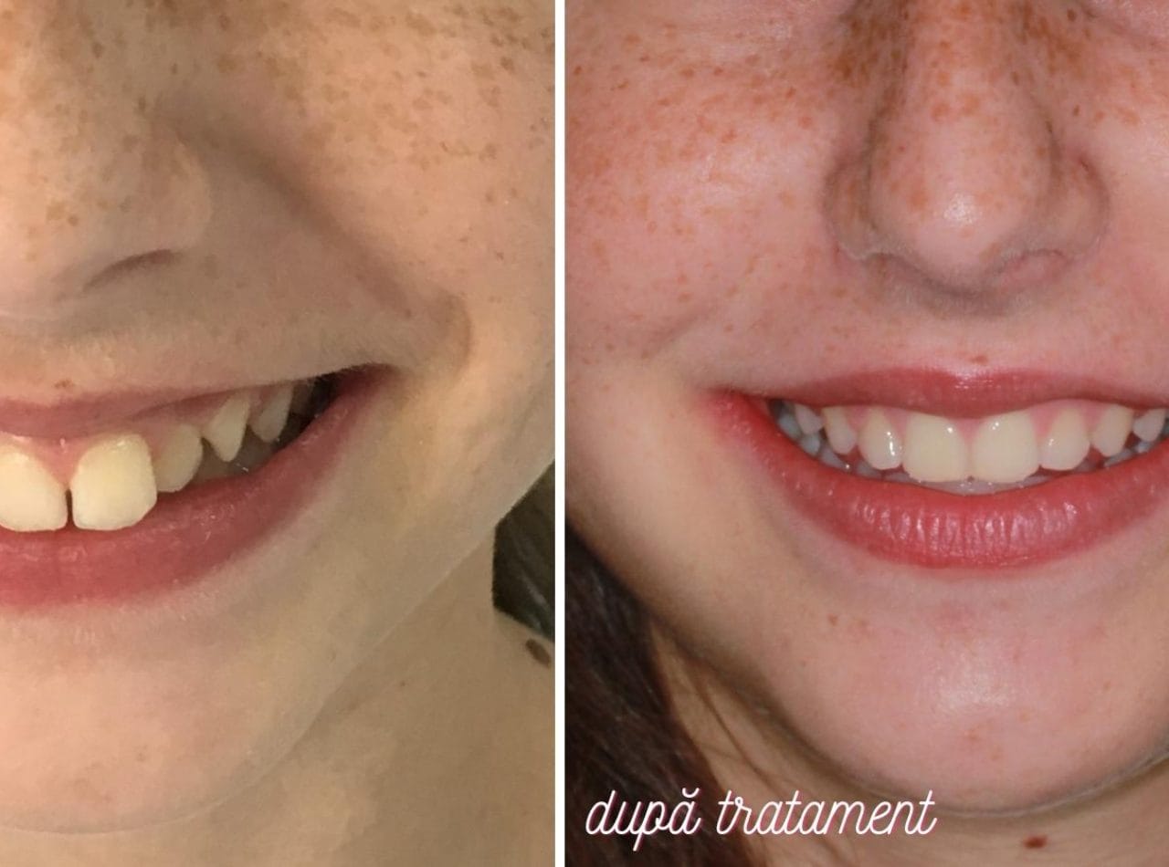 aparat dentar