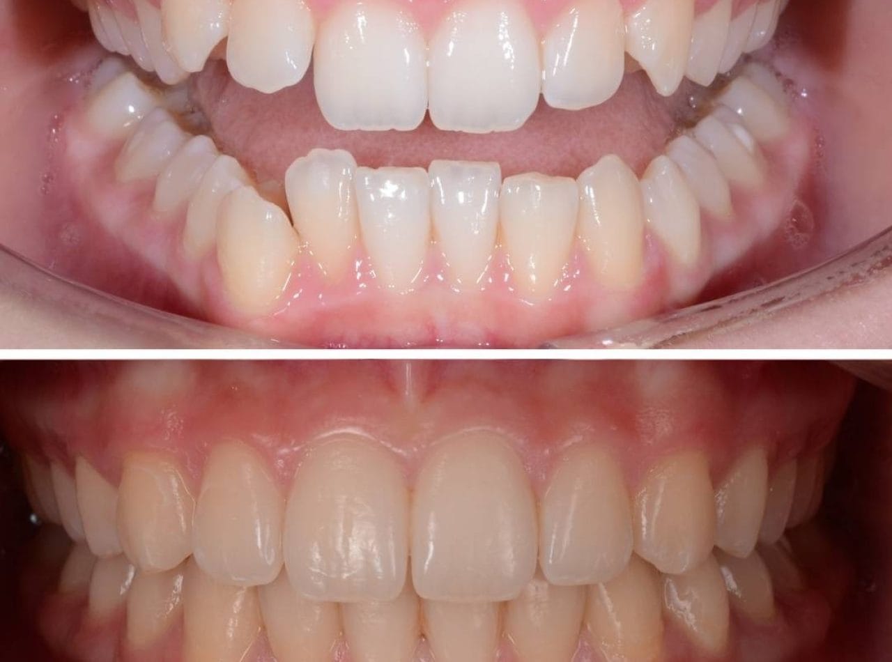 aparat dentar