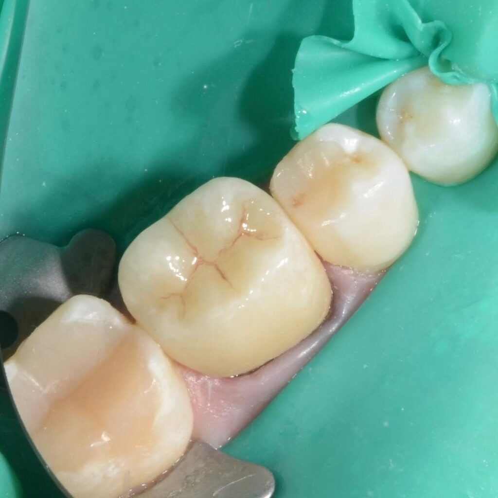 coroane dentare