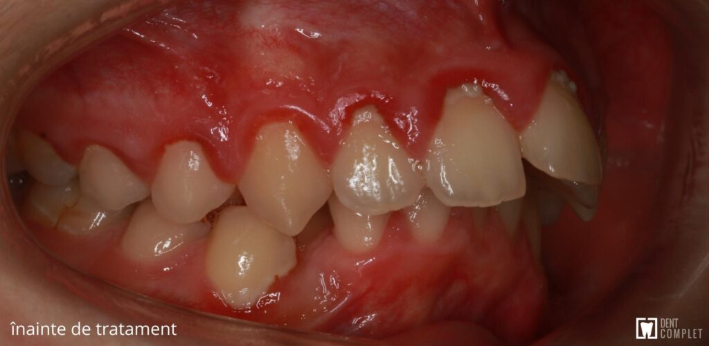 ocluzie dentară