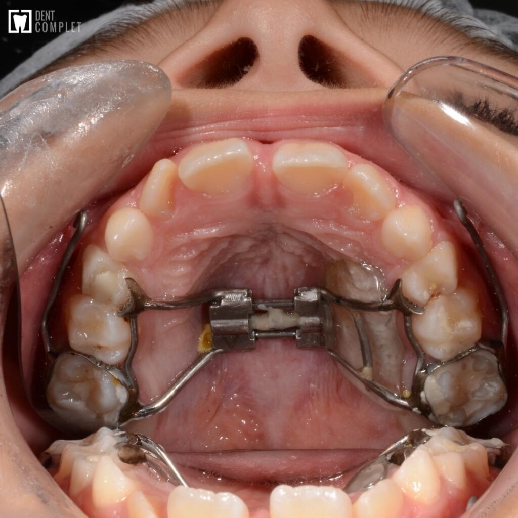 smoke Extensively Restrict Caz clinic: anomalii în dentația mixtă la pacient de 8.5 ani