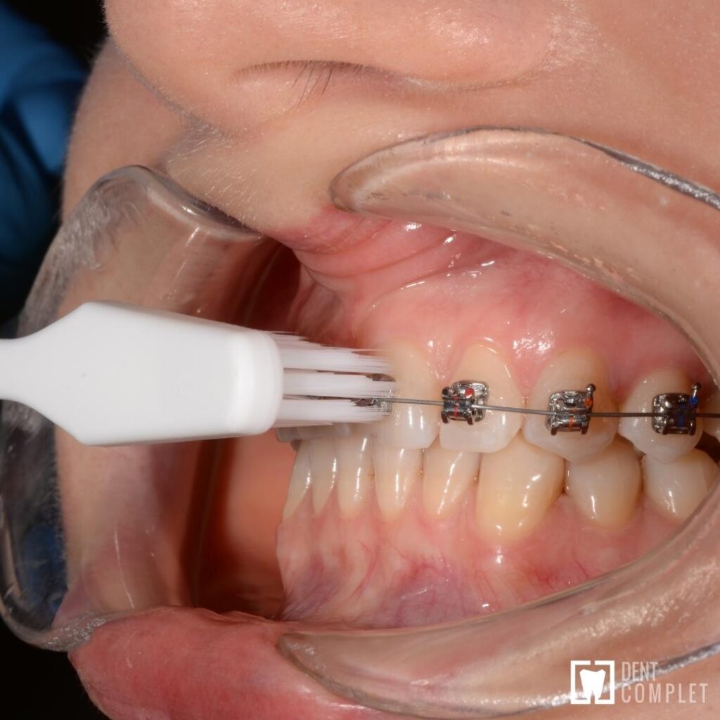 În ce direcție trebuie periați dinții care au aparat dentar fix?