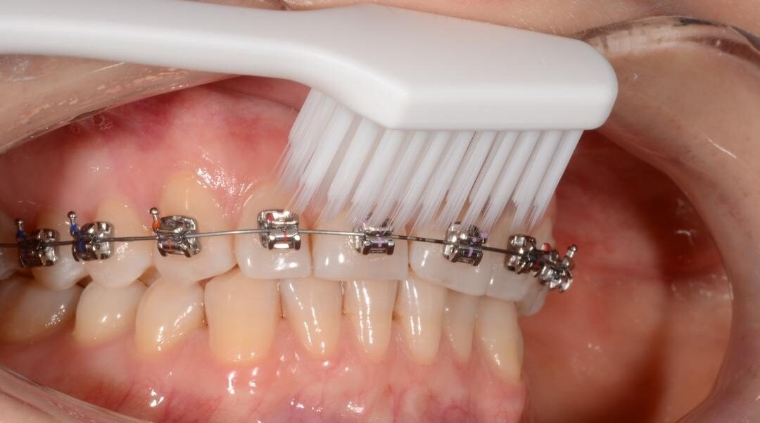 În ce direcție trebuie periați dinții care au aparat dentar fix?