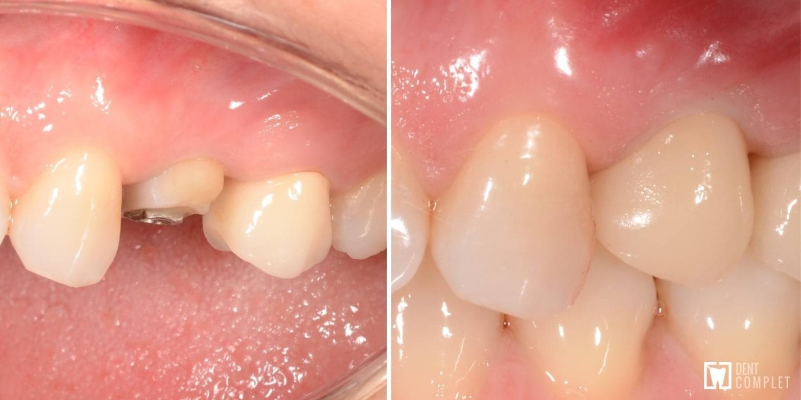 implant bredent