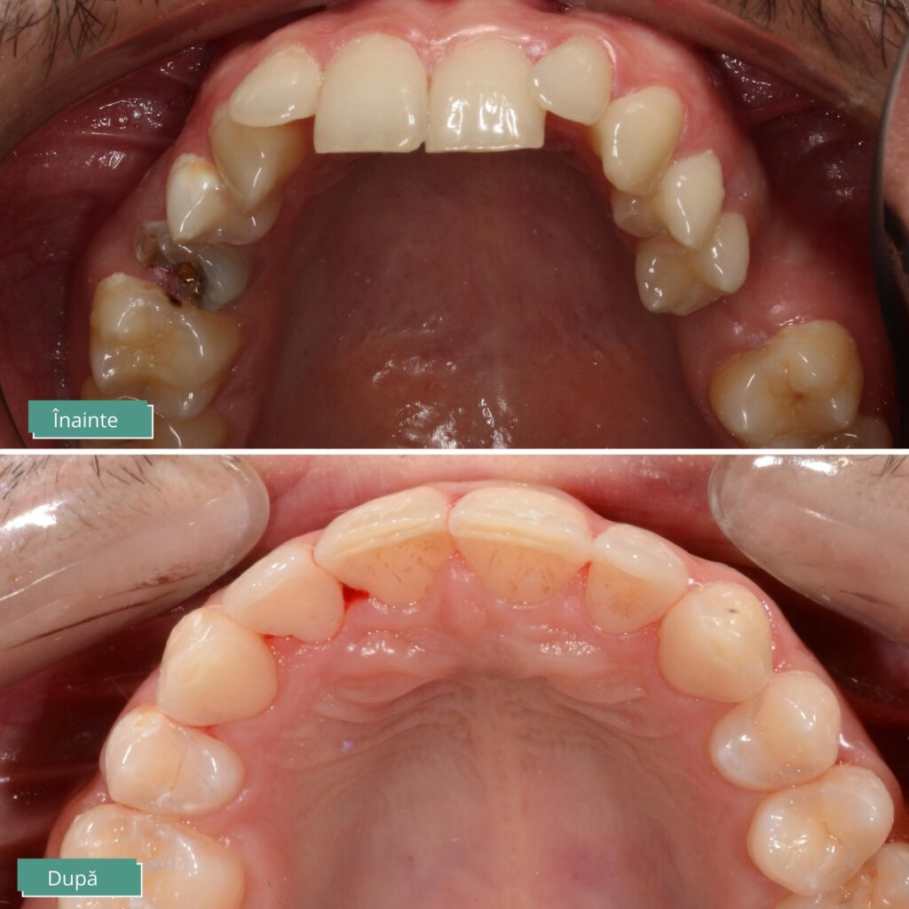 Fatal Against Residence Caz clinic: Beneficiile aparatului dentar fix - Dent Complet