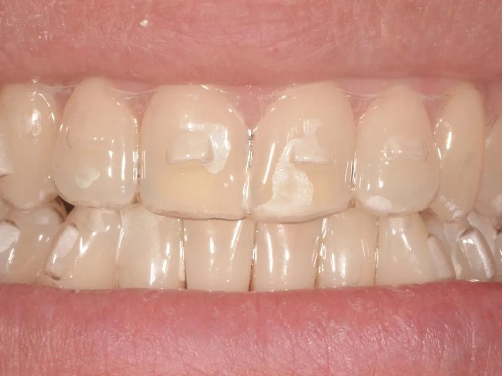 aparat dentar invizibil