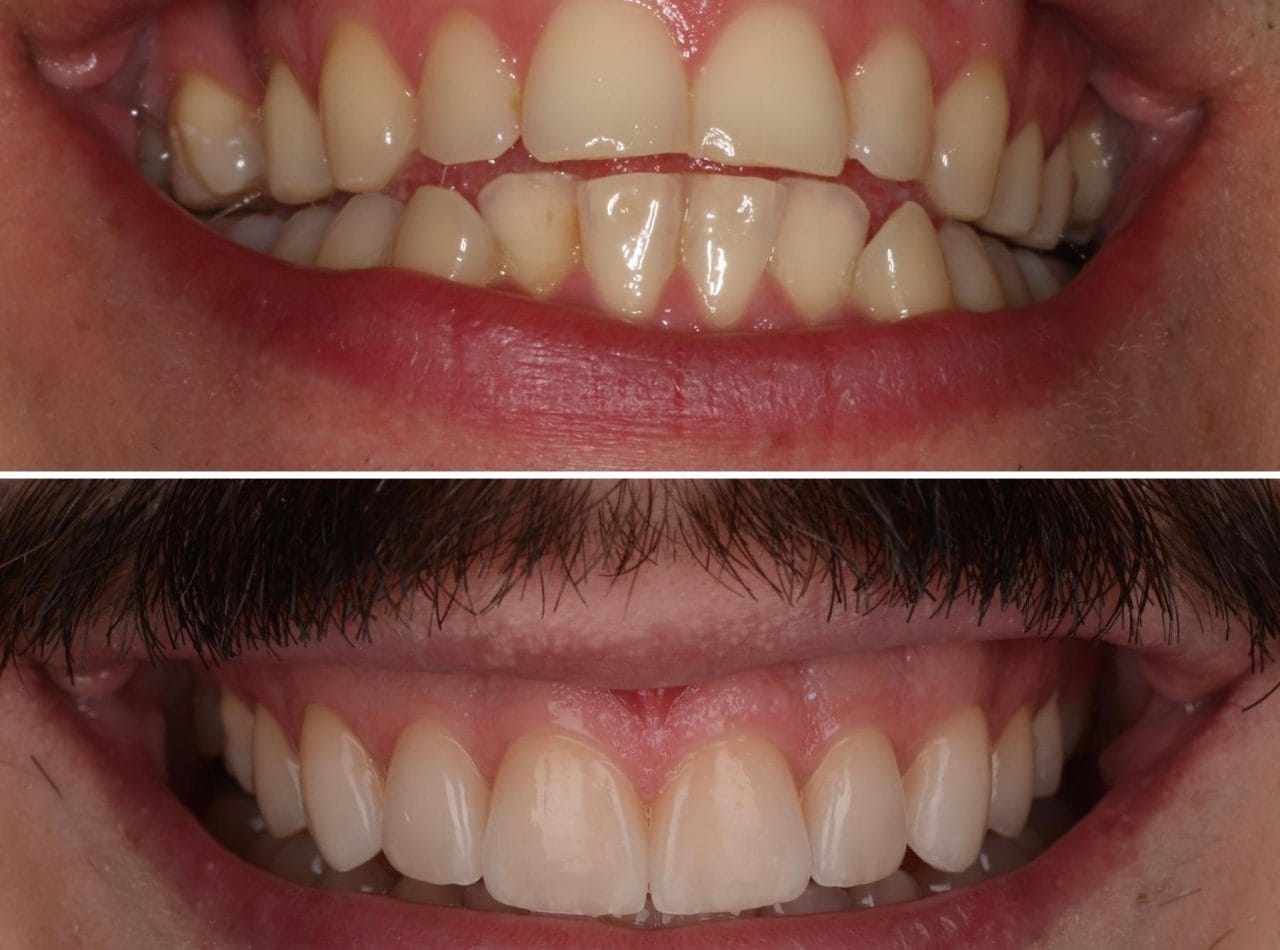 aparat dentar