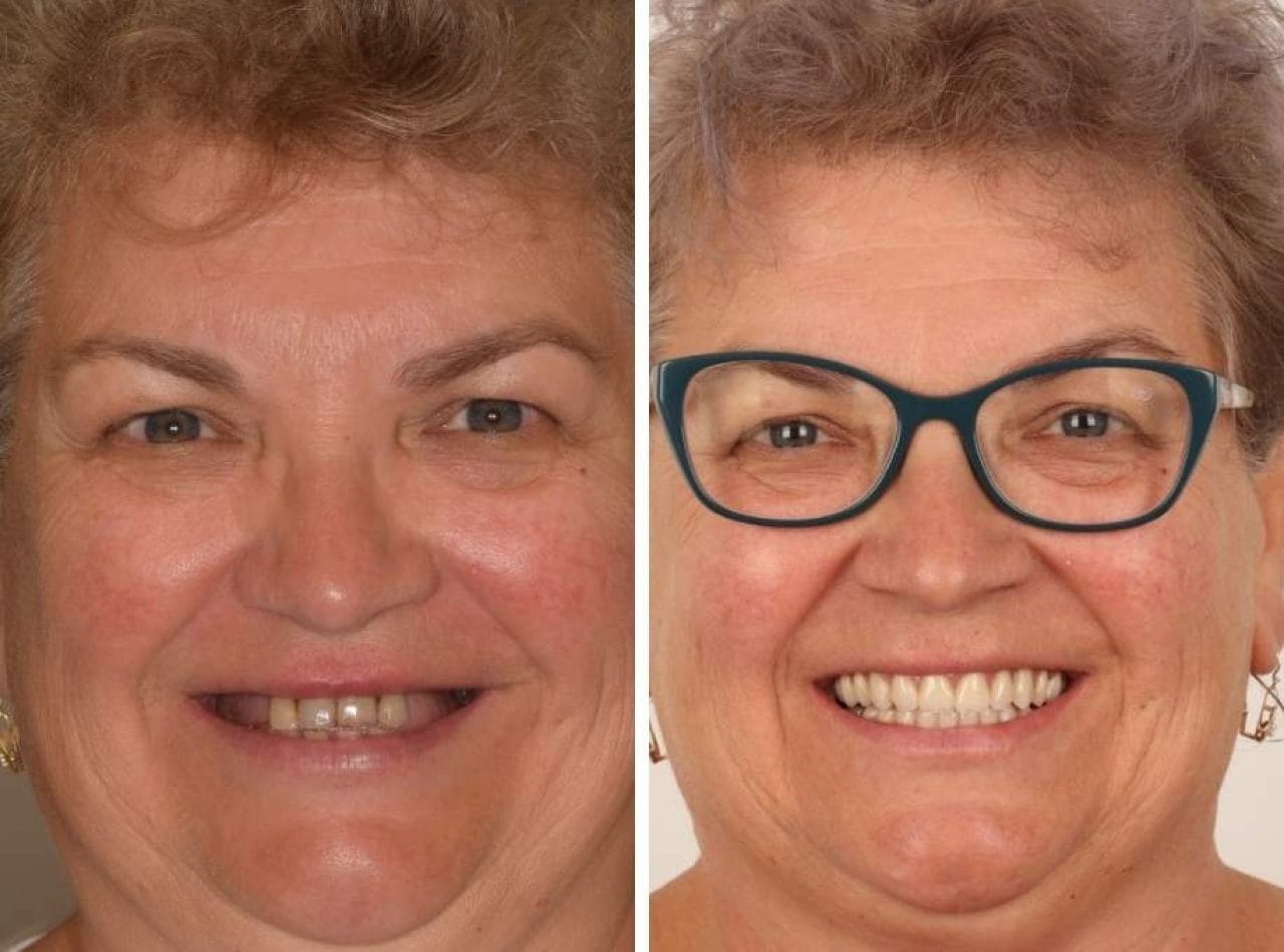 implant in 24 ore