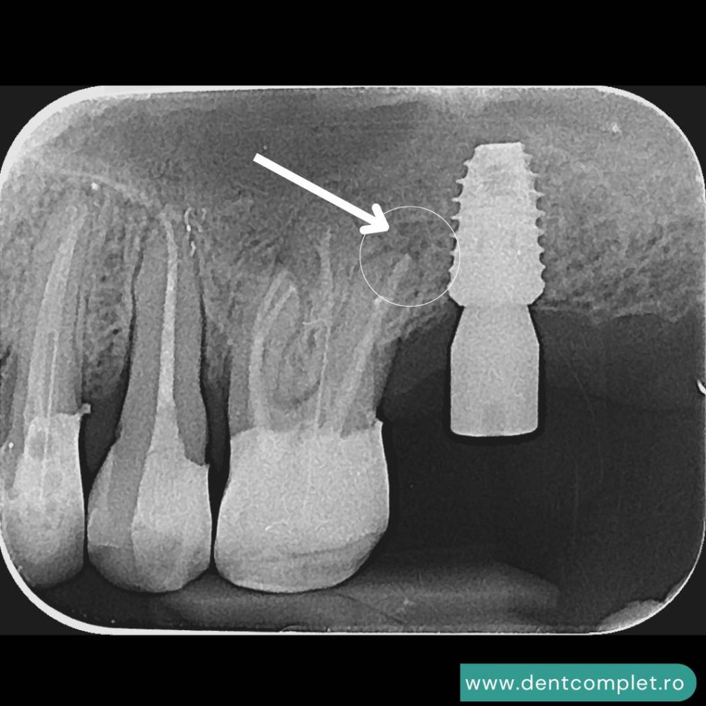 Retratament endodontic selectiv